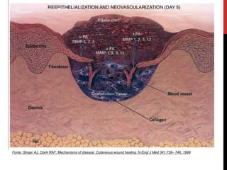 Fonte: Singer AJ, Clark RAF: Mechanisms of disease: Cutaneous wound healing. N Engl J Med 341:738– 746, 1999
 