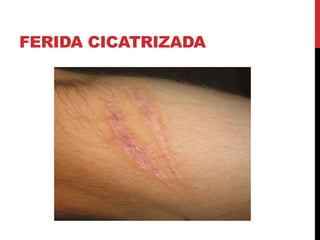 FERIDA CICATRIZADA
 