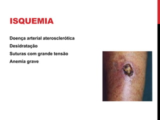 ISQUEMIA
Doença arterial aterosclerótica
Desidratação
Suturas com grande tensão
Anemia grave
 