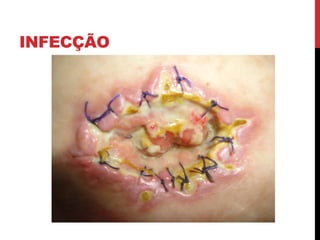 INFECÇÃO
 
