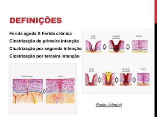 DEFINIÇÕES
Ferida aguda X Ferida crônica
Cicatrização de primeira intenção
Cicatrização por segunda intenção
Cicatrização por terceira intenção
Fonte: Internet
 