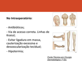 No Intraoperatório:
- Antibióticos;
- Via de acesso correta. Linhas de
Kraissl;
- Evitar ligadura em massa,
cauterização excessiva e
desvascularização tecidual;
- Hipotermia;
Fonte:Técnica em Cirurgia
Dermatológica 1ª Ed.
 