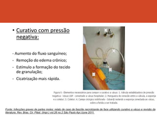 • Curativo com pressão
negativa:
- Aumento do fluxo sanguíneo;
- Remoção do edema crônico;
- Estímulo a formação do tecido
de granulação;
- Cicatrização mais rápida.
Fonte: Infecções graves de partes moles: relato de caso de fasciíte necrotizante de face utilizando curativo a vácuo e revisão da
literatura. Rev. Bras. Cir. Plást. (Impr.) vol.26 no.2 São Paulo Apr./June 2011.
 
