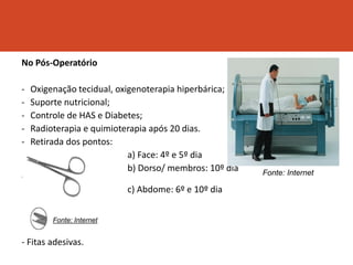 No Pós-Operatório
- Oxigenação tecidual, oxigenoterapia hiperbárica;
- Suporte nutricional;
- Controle de HAS e Diabetes;
- Radioterapia e quimioterapia após 20 dias.
- Retirada dos pontos:
a) Face: 4º e 5º dia
b) Dorso/ membros: 10º dia
ou mais
c) Abdome: 6º e 10º dia
- Fitas adesivas.
Fonte: Internet
Fonte: Internet
 