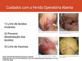 Cuidados com a Ferida Operatória Aberta
1) Livre de tecidos
inviáveis;
2) Prevenir
desidratação dos
tecidos;
3) Livre de traumas.
Fonte: Fasceíte Necrotizante Cervical em Lactente:
Relato de Caso. Arq. Int. Otorrinolaringol. / Intl. Arch. Otorhinolaryngol.,São Paulo, v.12, n.4,
p. 596-599, 2008.
 