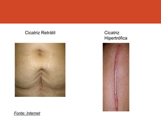 Cicatriz Retrátil Cicatriz
Hipertrófica
Fonte: Internet
 