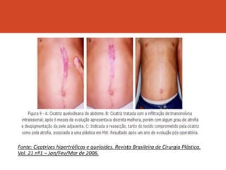 Fonte: Cicatrizes hipertróficas e queloides. Revista Brasileira de Cirurgia Plástica.
Vol. 21 nº1 – Jan/Fev/Mar de 2006.
 