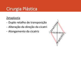 Cirurgia Plástica
Zetaplastia
- Duplo retalho de transposição
- Alteração da direção da cicatriz
- Alongamento da cicatriz
 