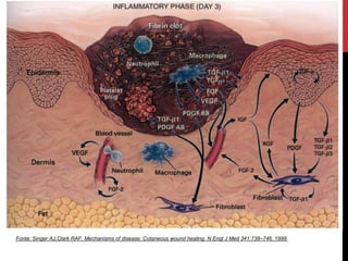 Fonte: Singer AJ,Clark RAF: Mechanisms of disease: Cutaneous wound healing. N Engl J Med 341:738–746, 1999.
 