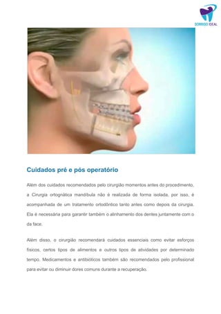 Cirurgia de mandíbula - Consulta Ideal