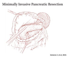Trauma Pancreático
• 5% dos casos
• Cinemática
• Amilase
• Tomografia
Fundamentos da Cirurgia Pancreática
 