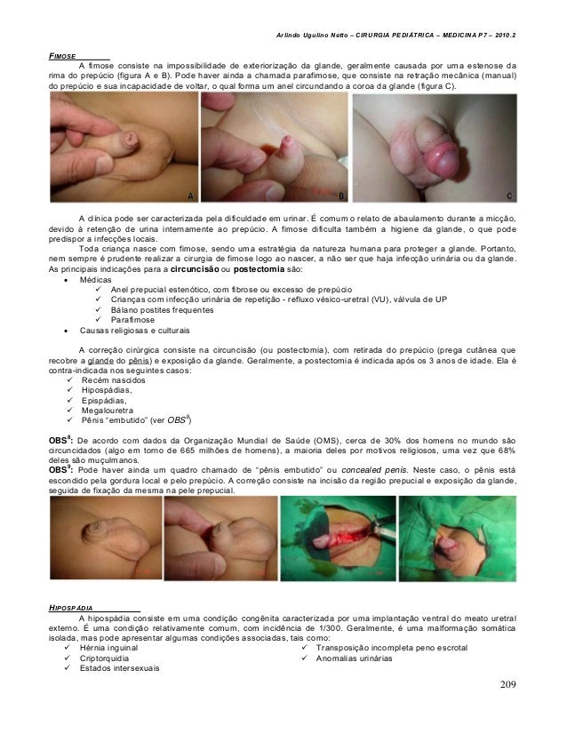Cirurgia Pediatrica Completa Cirurgia Pediatrica Completa