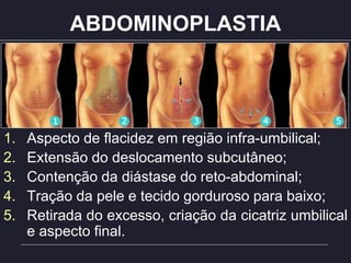 ABDOMINOPLASTIA
1. Aspecto de flacidez em região infra-umbilical;
2. Extensão do deslocamento subcutâneo;
3. Contenção da diástase do reto-abdominal;
4. Tração da pele e tecido gorduroso para baixo;
5. Retirada do excesso, criação da cicatriz umbilical
e aspecto final.
 