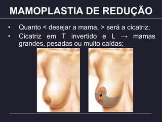 MAMOPLASTIA DE REDUÇÃO
• Quanto < desejar a mama, > será a cicatriz;
• Cicatriz em T invertido e L → mamas
grandes, pesadas ou muito caídas;
 