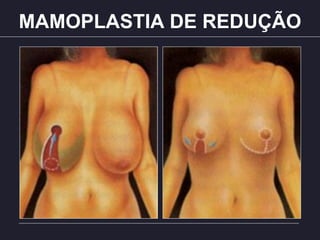 MAMOPLASTIA DE REDUÇÃO
 