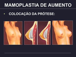 MAMOPLASTIA DE AUMENTO
• COLOCAÇÃO DA PRÓTESE:
 