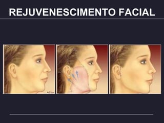 REJUVENESCIMENTO FACIAL
 