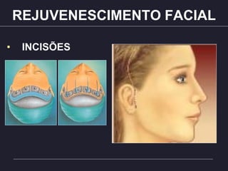 REJUVENESCIMENTO FACIAL
• INCISÕES
 