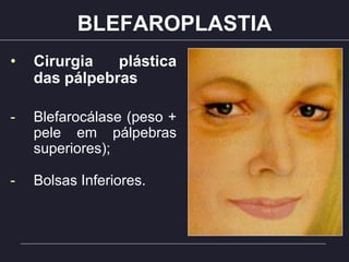 BLEFAROPLASTIA
• Cirurgia plástica
das pálpebras
- Blefarocálase (peso +
pele em pálpebras
superiores);
- Bolsas Inferiores.
 