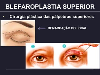 BLEFAROPLASTIA SUPERIOR
• Cirurgia plástica das pálpebras superiores
DEMARCAÇÃO DO LOCAL
 