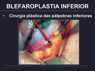 BLEFAROPLASTIA INFERIOR
• Cirurgia plástica das pálpebras inferiores
 