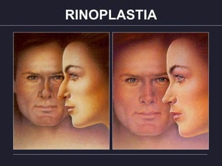 RINOPLASTIA
 