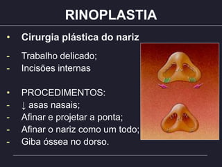 RINOPLASTIA
• Cirurgia plástica do nariz
- Trabalho delicado;
- Incisões internas
• PROCEDIMENTOS:
- ↓ asas nasais;
- Afinar e projetar a ponta;
- Afinar o nariz como um todo;
- Giba óssea no dorso.
 