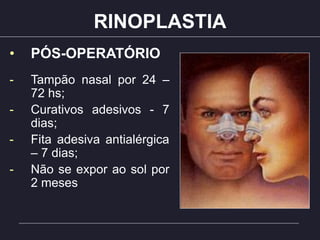 RINOPLASTIA
• PÓS-OPERATÓRIO
- Tampão nasal por 24 –
72 hs;
- Curativos adesivos - 7
dias;
- Fita adesiva antialérgica
– 7 dias;
- Não se expor ao sol por
2 meses
 