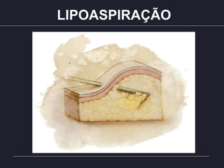 LIPOASPIRAÇÃO
 
