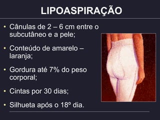 LIPOASPIRAÇÃO
• Cânulas de 2 – 6 cm entre o
subcutâneo e a pele;
• Conteúdo de amarelo –
laranja;
• Gordura até 7% do peso
corporal;
• Cintas por 30 dias;
• Silhueta após o 18º dia.
 