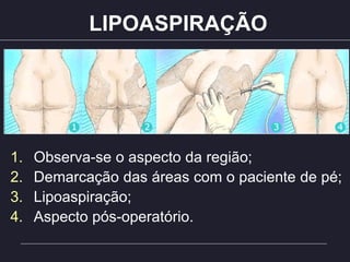 LIPOASPIRAÇÃO
1. Observa-se o aspecto da região;
2. Demarcação das áreas com o paciente de pé;
3. Lipoaspiração;
4. Aspecto pós-operatório.
 