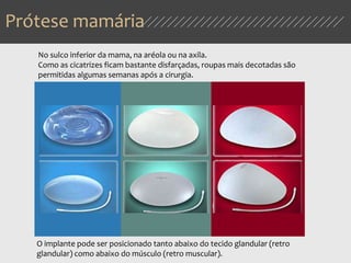Prótese mamária
No sulco inferior da mama, na aréola ou na axila.
Como as cicatrizes ficam bastante disfarçadas, roupas mais decotadas são
permitidas algumas semanas após a cirurgia.
O implante pode ser posicionado tanto abaixo do tecido glandular (retro
glandular) como abaixo do músculo (retro muscular).
 