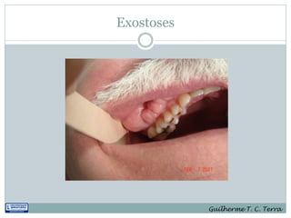 Exostoses




            Guilherme T. C. Terra
 