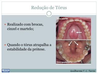 Redução de Tórus


 Realizado com brocas,
 cinzel e martelo;



 Quando o tórus atrapalha a
 estabilidade da prótese.




                                   Guilherme T. C. Terra
 
