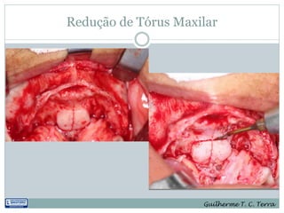 Redução de Tórus Maxilar




                     Guilherme T. C. Terra
 