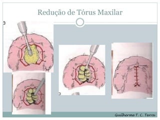 Redução de Tórus Maxilar




                     Guilherme T. C. Terra
 