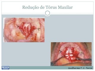 Redução de Tórus Maxilar




                     Guilherme T. C. Terra
 