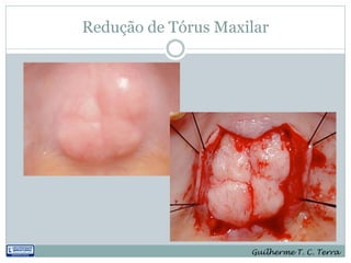 Redução de Tórus Maxilar




                     Guilherme T. C. Terra
 