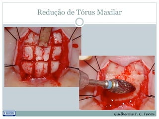 Redução de Tórus Maxilar




                     Guilherme T. C. Terra
 