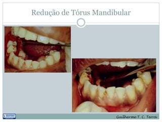 Redução de Tórus Mandibular




                       Guilherme T. C. Terra
 