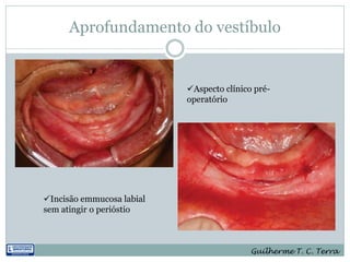 Aprofundamento do vestíbulo


                           Aspecto clínico pré-
                           operatório




Incisão emmucosa labial
sem atingir o perióstio



                                           Guilherme T. C. Terra
 