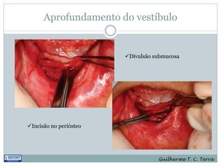 Aprofundamento do vestíbulo


                        Divulsão submucosa




Incisão no periósteo




                                   Guilherme T. C. Terra
 