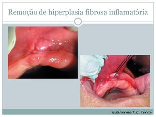 Remoção de hiperplasia fibrosa inflamatória




                               Guilherme T. C. Terra
 