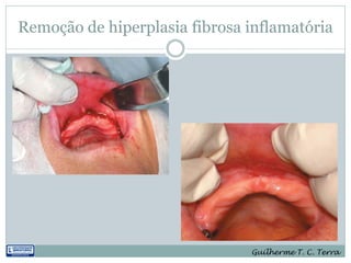 Remoção de hiperplasia fibrosa inflamatória




                               Guilherme T. C. Terra
 