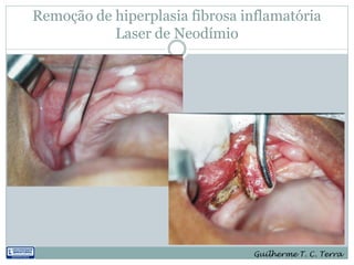 Remoção de hiperplasia fibrosa inflamatória
           Laser de Neodímio




                                Guilherme T. C. Terra
 