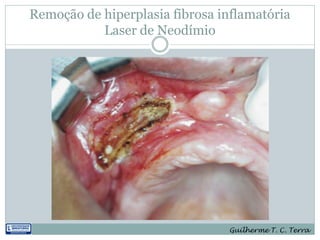 Remoção de hiperplasia fibrosa inflamatória
           Laser de Neodímio




                                Guilherme T. C. Terra
 