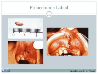 Frenectomia Labial




                     Guilherme T. C. Terra
 