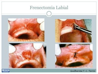 Frenectomia Labial




                     Guilherme T. C. Terra
 