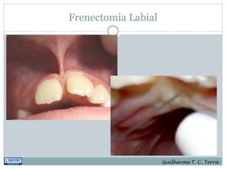 Frenectomia Labial




                     Guilherme T. C. Terra
 