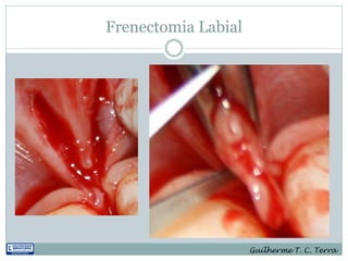 Frenectomia Labial




                     Guilherme T. C. Terra
 
